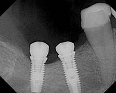 Dental implant